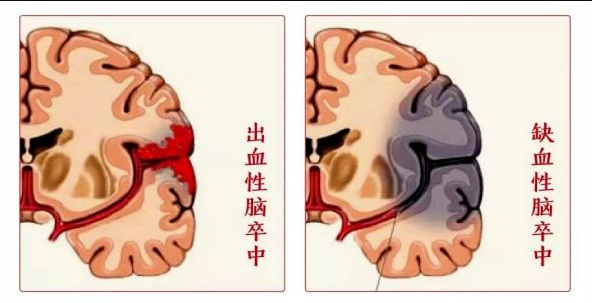 脑血管病的预防，从现在做起！